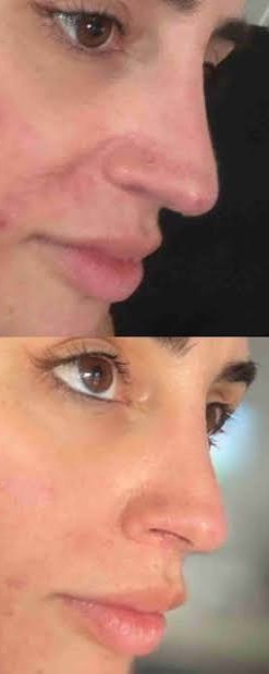 Acne & post-acne marks — after treatment