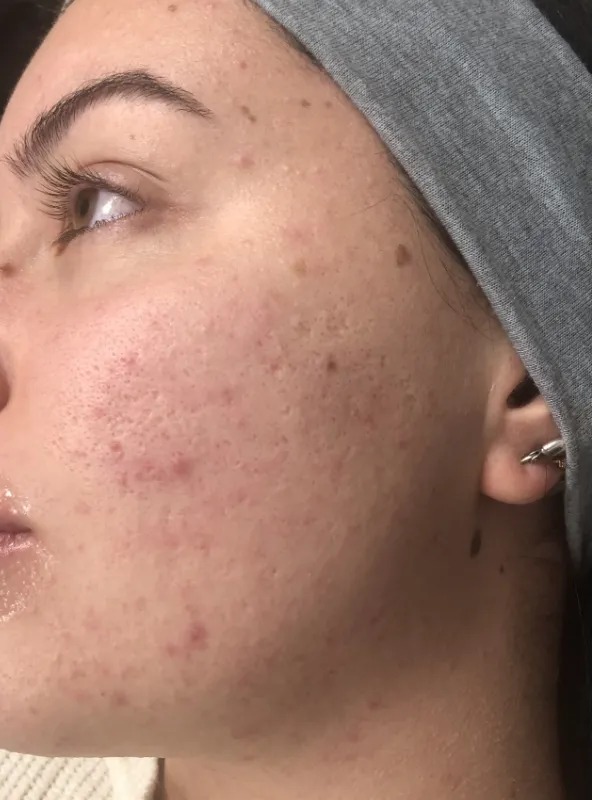 Acne scars & texture — before treatment